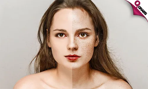Laser Rejuvenation for Dark Lips & Freckles/Sunspots Treatment!